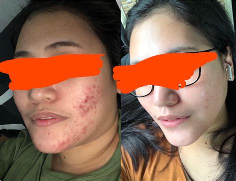 248 best Azelaic Acid images on Pholder | Skincare Addiction, Tretinoin