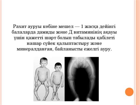 Мешел (рахит) ауруы - презентация онлайн