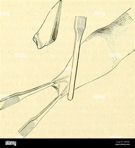 Phimosis hi-res stock photography and images - Alamy
