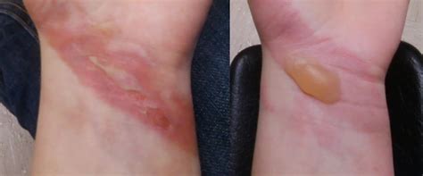 first degree burns