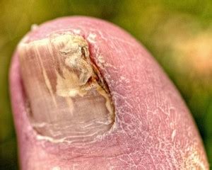How Gangrene Affects Feet And Toes