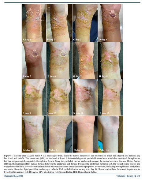 The Leak's Emotional Scars: Brandy Renee's Family's Healing Process