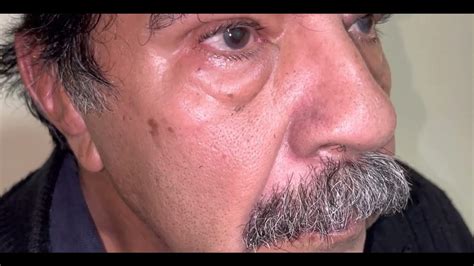 signo de meyerson youtube