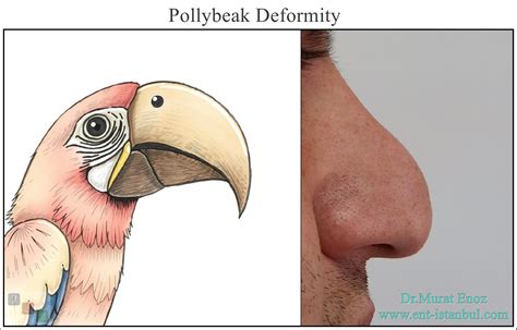 Pollybeak Nose Deformity - Definition, Causes and Treatment