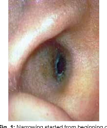 Figure 2 from Late Presentation of Idiopathic Tympanic Membrane ...