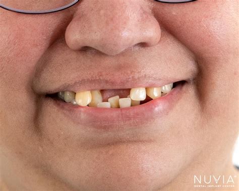 bad teeth    options solutions