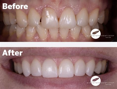 Veneers Before and After By Dr Kasen