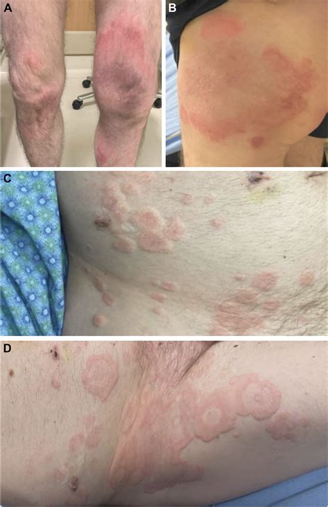Hypocomplementemic Urticarial Vasculitis