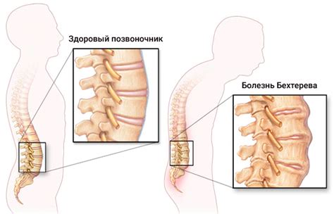 Болезнь Бехтерева: симптомы, диагностика и лечение