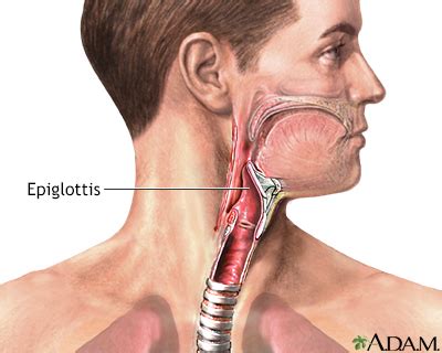 epiglottitis information mount sinai  york