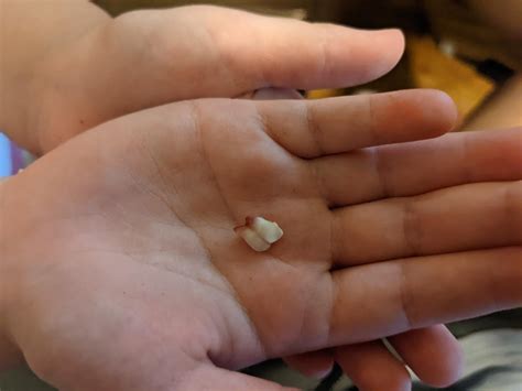 fused teeth normal raskdentists