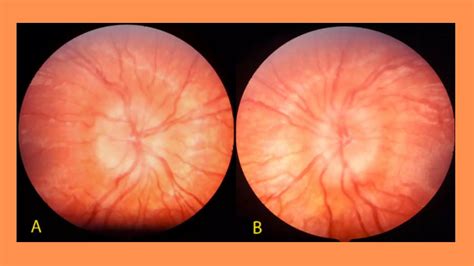 Adrenal insufficiency associated with prepubertal pediatric pseudotumor ...