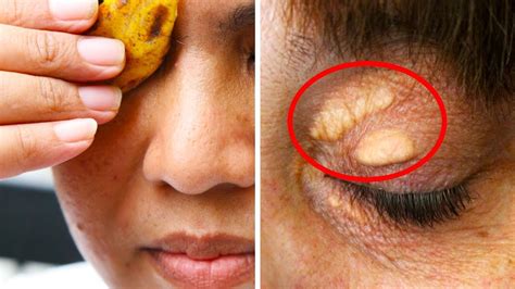 How To Hide Cholesterol Spots With Makeup | Makeupview.co