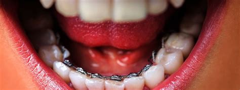 3 Pitfalls of Lingual Braces and How to Avoid Them