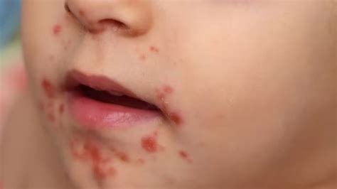 Alerta en Hidalgo por virus Coxsackie: ¿Qué es y cuáles son los síntomas?