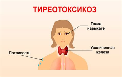 Тиреотоксикоз щитовидной железы: что это такое, симптомы у женщин ...