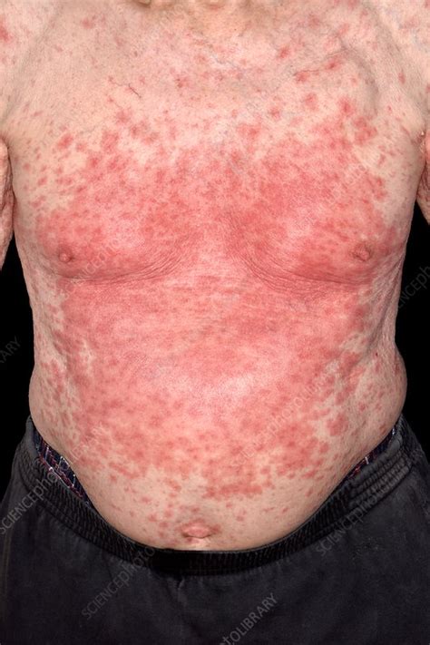 Skin Rash Treatment Allergic Reaction at Jose Orr blog