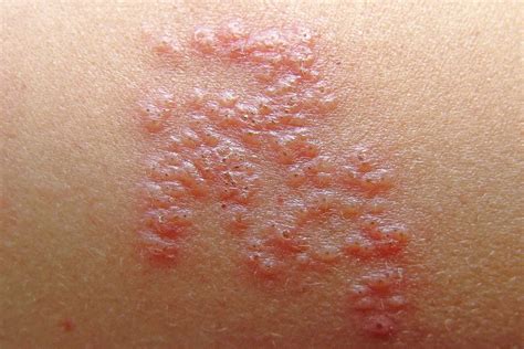 shingles treatment medication  prevention pain relief antiviral