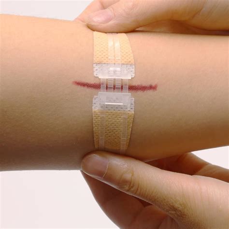 should i cover wound after stitches removed 1