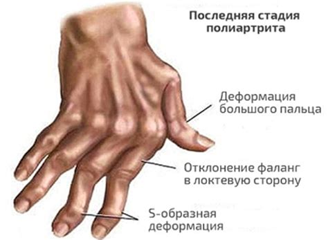 Полиартрит рук – почему возникает и как вылечить?