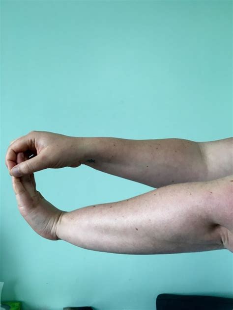 Wrist flexor stretch - Thorpes Physiotherapy