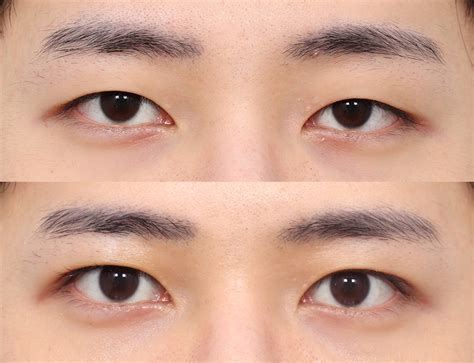 Male Rhinoplasty | Male Plastic Surgery | AB Plastic Surgery Korea