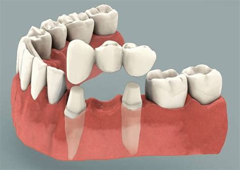 Most dentystyczny: rodzaje, które są lepsze, jak zrobić i umieścić, ile ...