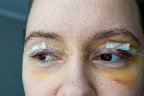 Wound closure Зображення, стокові фотографії та картинки Wound closure