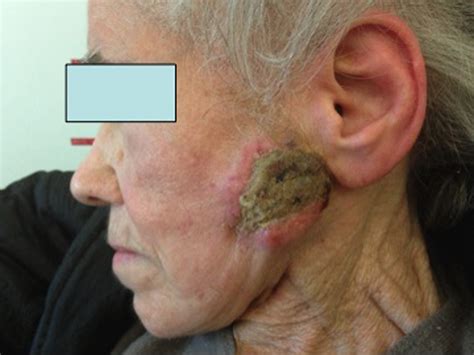 Ulcerated skin lesion of the left parotid | Download Scientific Diagram