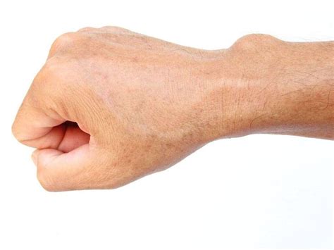 Ganglion Cyst: What Is a Ganglion cyst?