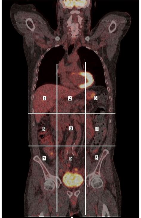 simplified pci   scoring  radiological pci