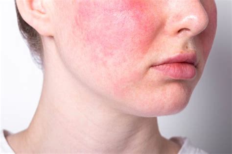 treat rosacea skincare  professional treatments  red