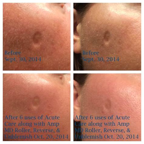 pock marks    anti ageing routine diy anti aging anti