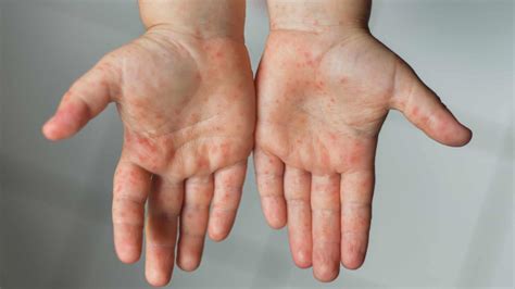 jenis ruam merah  kulit dewasa  anak anak  bentuknya