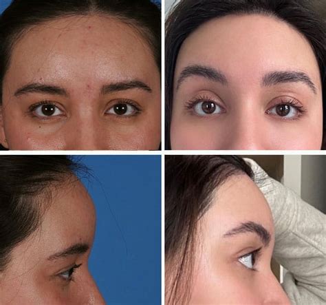forehead reduction dr ali totonchi