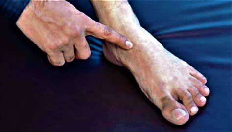Navicular fracture causes, symptoms, diagnosis, treatment & prognosis