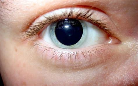 Detecting Concussion Through Dilated Pupils