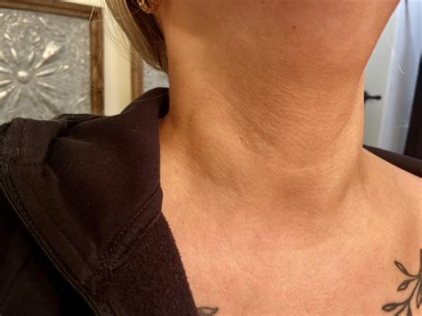 Should You Apply Heat To Swollen Lymph Nodes at Rebecca Castillo blog