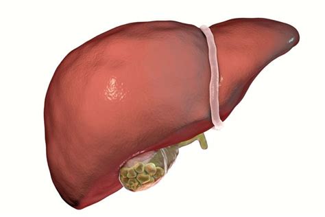 Bladder Stones: Symptoms, Treatments, and Prevention - Facty Health