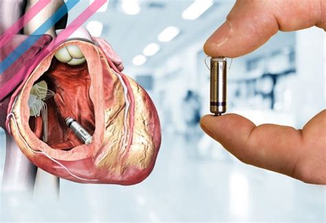 implantable pacemaker