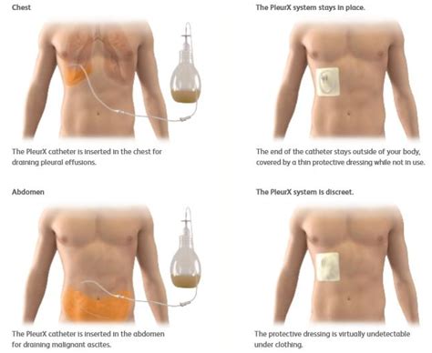 CareFusion 50-7000B PleurX Pleural Catheter, 54% OFF