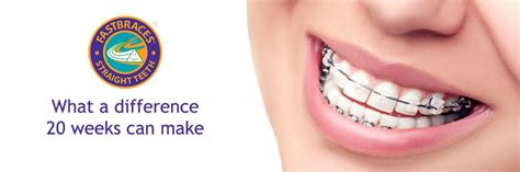 fastbraces idaho falls id park west dental care