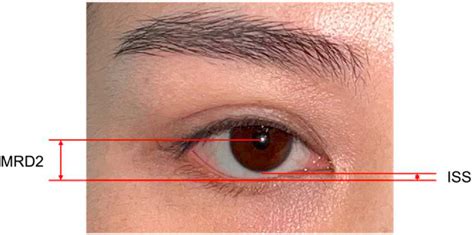 light source    front   patient mrd  defined