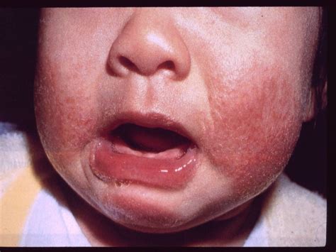 Baby eczema: causes, symptoms, treatment and more