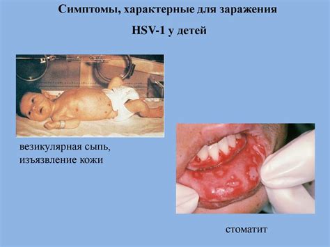 Вирус герпеса - презентация онлайн