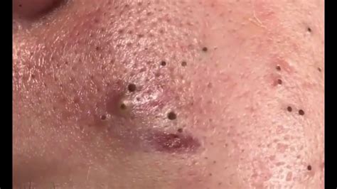 Newest 2024 Blackhead Removal Video - Julia Isadora