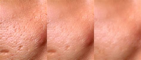 IPixel Laser Resurfacing Treatment In Leeds - The Leeds Clinic