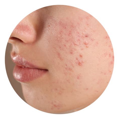 Is Non Comedogenic Skincare A Thing