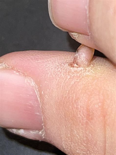 Cutaneous Horn
