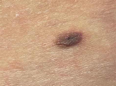 Spontaneous Bleeding from mole. : r/Melanoma